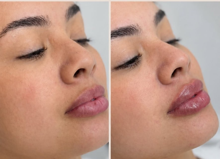 Antes e depois de preenchimento labial