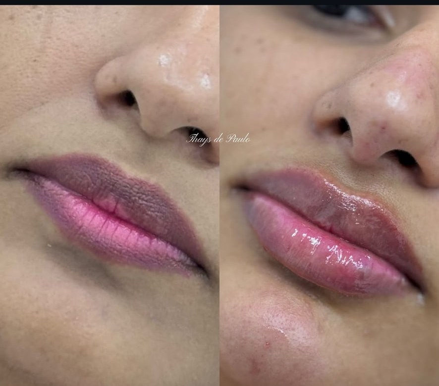 Antes e depois de lábios hidratados e com volume
