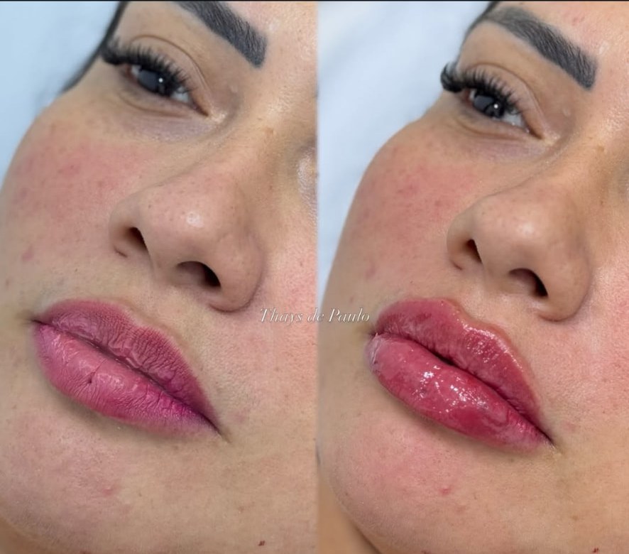 Antes e depois de lábios mais definidos